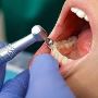 Teeth Scaling And Polishing in Houston