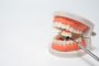 What Is a Dental Implant?