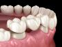 Missing Teeth? Find Solutions in Aberdeen, MS