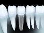 Dental Implants and Denture Replacement