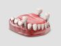 Transform Your Oral Health with Complete Mouth Implants in N