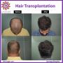 Best Hair Transplantation in Bangalore | Hair Grafting Cost 