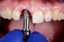 Premium Dental Implant Services Now at Deniliquin