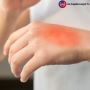 Get Today The Burn Injury Lawyer in Los Angeles