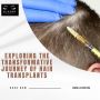 Exploring the Transformative Journey of Hair Transplants