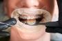 Braces and Orthodontic Treatment in Livonia