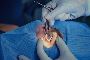 Cataract treatment in kerala