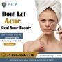Best Acne Treatment in Moorestown, NJ - Get Clearer Skin Now