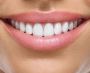 Revolutionizing Smiles with Custom Dental Aligners