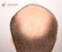 Effective Solutions for Thinning Hair by Dr. Nav Vikram Kamb