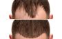 Top Hair Transplant Surgeon in India - NeoGraft Hair Clinic