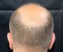 Expert Hair Transplant Doctor in Chandigarh, India
