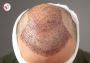 Top Hair Transplant Clinic in India? NeoGraft Hair Clinic