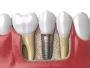 Expert Dental Fillings in Thousand Oaks