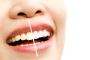 Dazzling Smiles with Franklin Canberra Teeth Whitening!