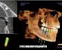BURUTE DENTAL Advanced Implant Center - Exclusive for Dental