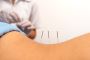 Dry Needling Physical Therapy | Optimal Physical Therapy| 
