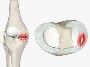 5 Measure to do for ankle ligament