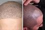 Best treatment for Scalp Micro Pigmentation in Fairview