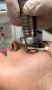 Proctology Laser Machine Manufacturers – Phoxton Proctology Laser Machine Manufacturers – Phoxton