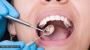 best implant dentist in delhi