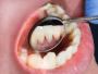 Reduce Bacterial Infection by Laser Teeth Cleaning