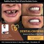 Best Clinic for Dental Crown in Ghaziabad
