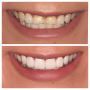 Captivate Confidence With Your Hollywood Smile Porcelain