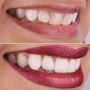 Revitalise Your Smile with Porcelain Veneers Sydney