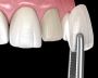 Affordable Dental Veneers in Houston, TX