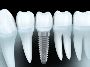 Achieve a Flawless Smile with Complete Dental Implants at Pr