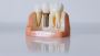 Top Clinics Offering All on 4 Dental Implants in Melbourne