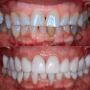 Discover Affordable Dental Veneers in Mexico 