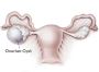 Cyst Removal Surgery In Delhi