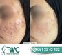 Laser Treatment For Acnes cars in Islamabad - Acnes cars-RMC