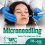 Microneedling Therapy in Islamabad - Best Microneedling-RMC