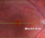 Macular Hole Surgery Specialist in UK - Retina Surgeon