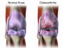 osteoarthritis treatment in bangalore