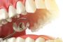 Best Dentist in Bangalore | Ridgetop Dental International
