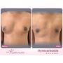 Why is Gynecomastia Surgery Done?