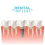 Your Guide to a Strong and Stunning Dental Implant Abutment