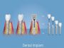 Dental Implant Abutment - Brand New, Great Price!