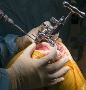 Best knee replacement surgeon in indore - Dr. Vinay Tantuway