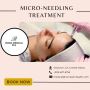 Remove Wrinkles with Micro-needling Treatment | Roma Skin He