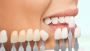 Smile confidently with porcelain veneers - Roseland Dental