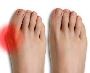 6 bunion treatment ease of pain in Singapore
