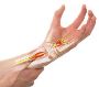 5 Outcomes of Carpal Tunnel Syndrome Treatment 