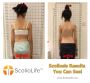 Get The Best Scoliosis Treatment | Amazing Results