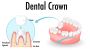 Discover the Best Crowns at Seattle Smiles Dental