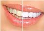 Chemical-Free Teeth Whitening: Natural Alternatives 